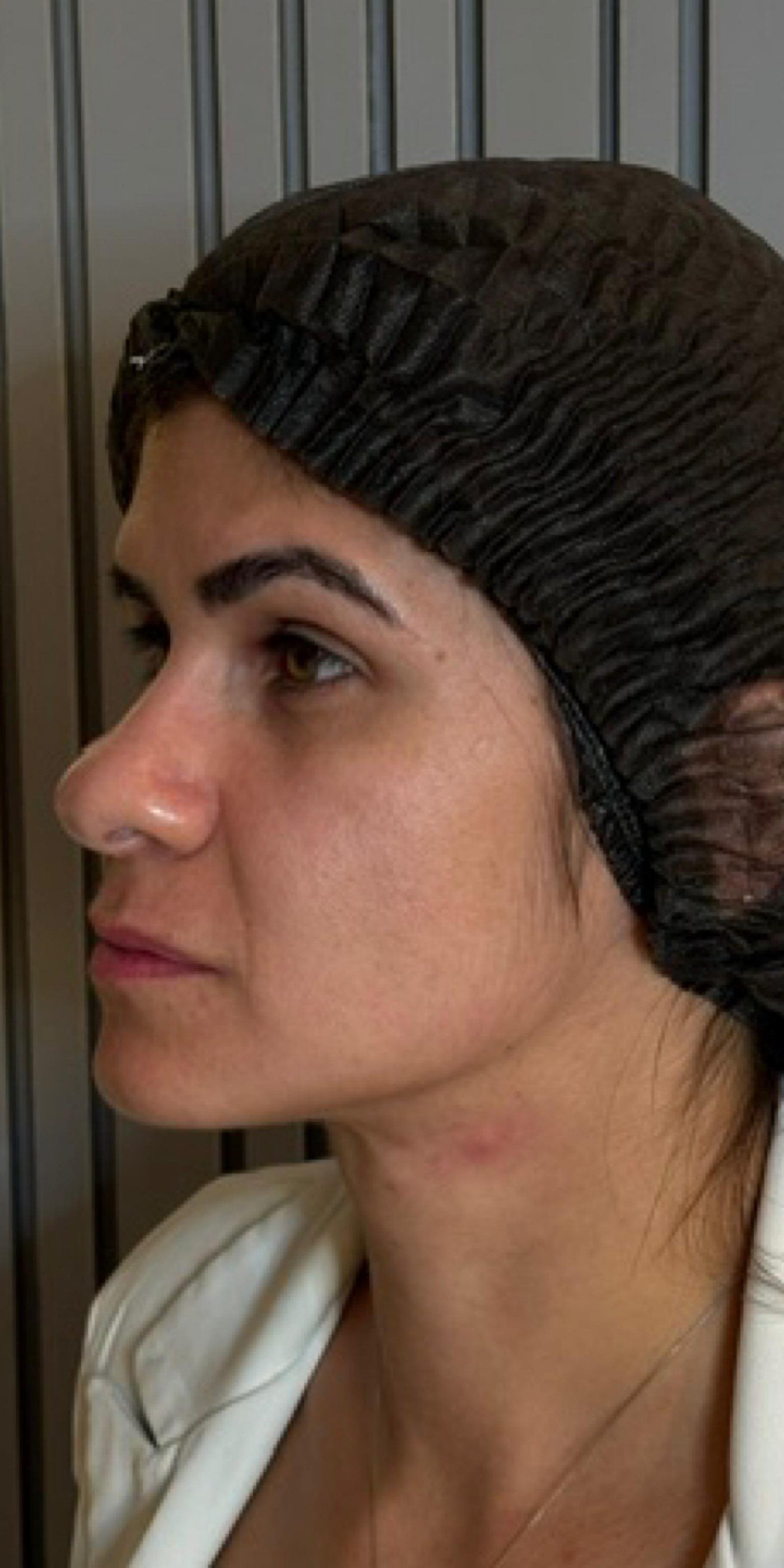 Perfil do rosto de paciente antes do planejamento facial completo