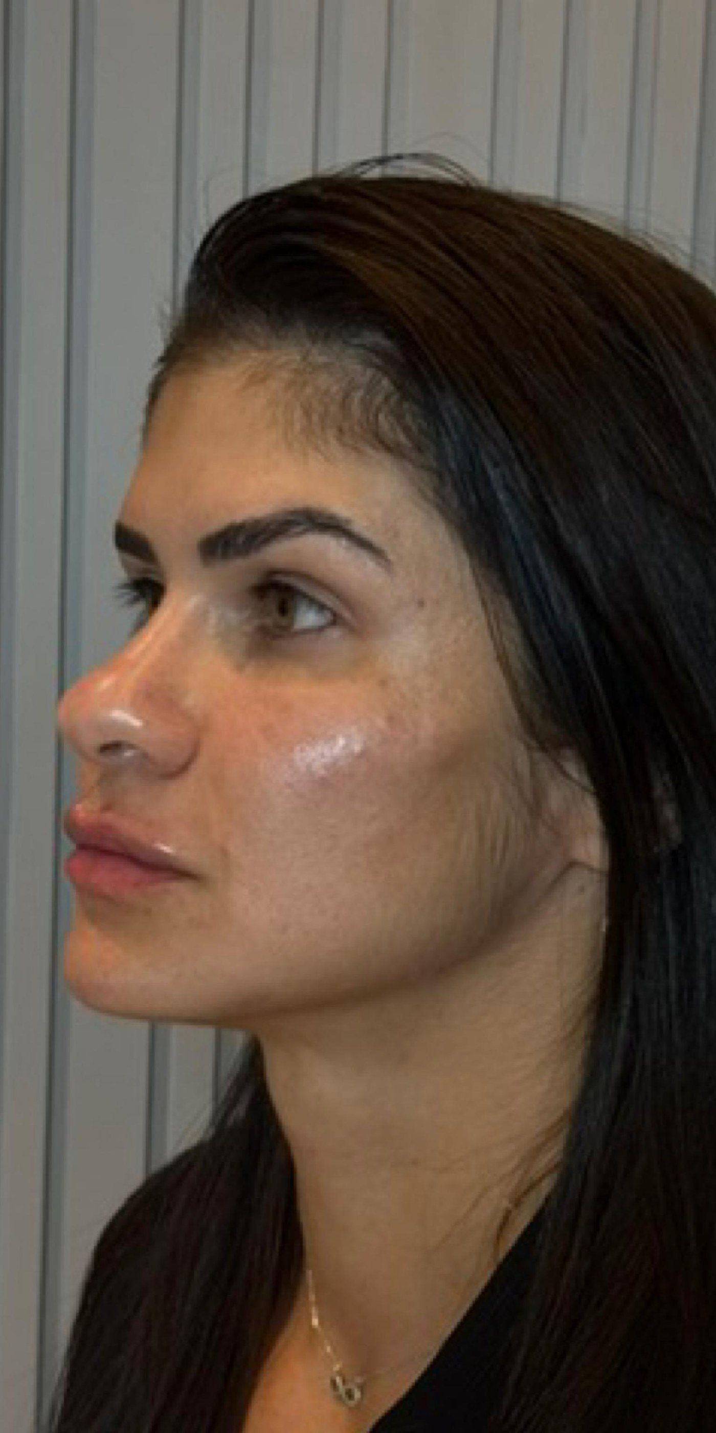 Perfil do rosto da mesma paciente após o planejamento facial completo em etapas
