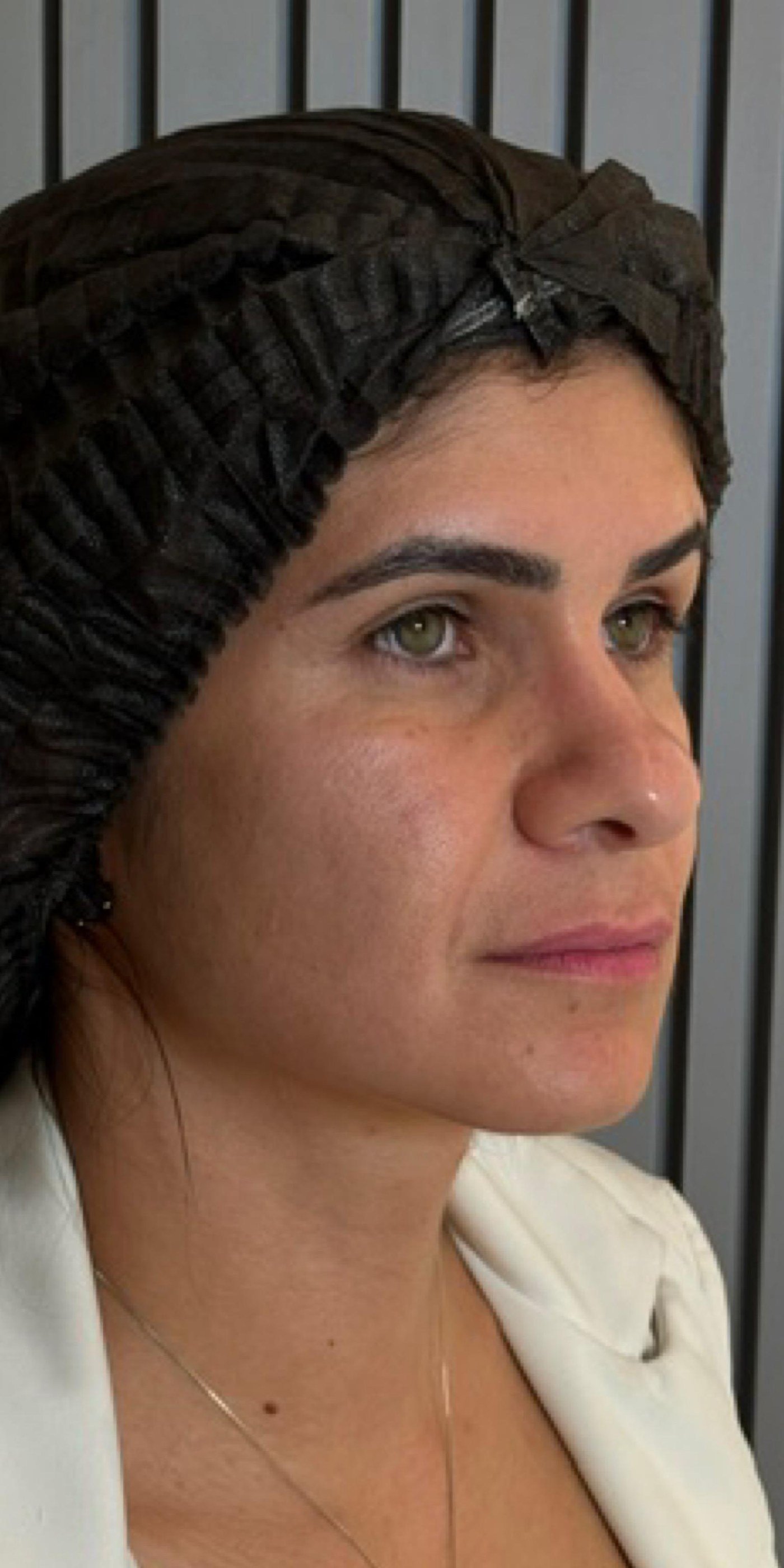 Rosto de paciente em três quartos antes do planejamento facial completo