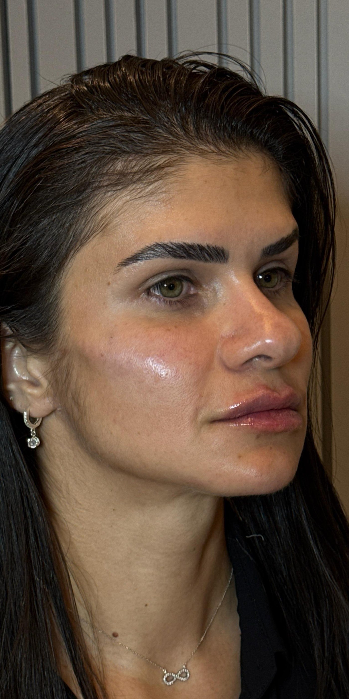 Rosto da mesma paciente em três quartos após o planejamento facial completo em etapas